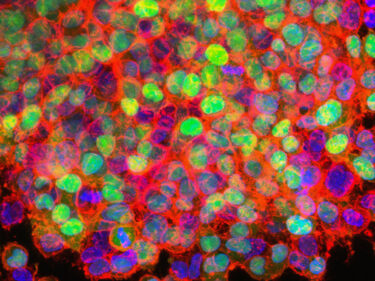 lung cancer cells