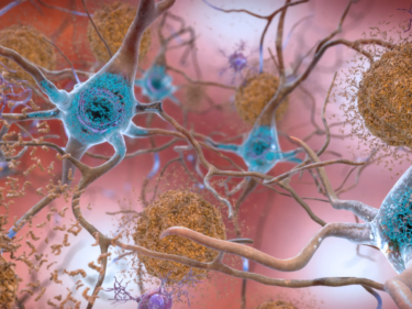 Beta-amyloid plaques and tau in the brain