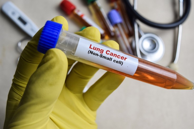Lung cancer sample in a test tube